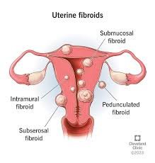 uterine fibroids