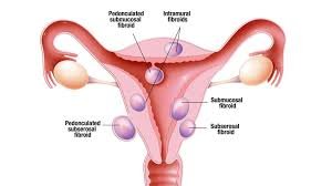 fibroids