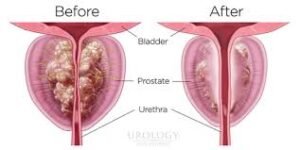 enlarged prostate treatment