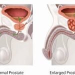 enlarged prostate treatment