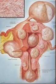 fibroids